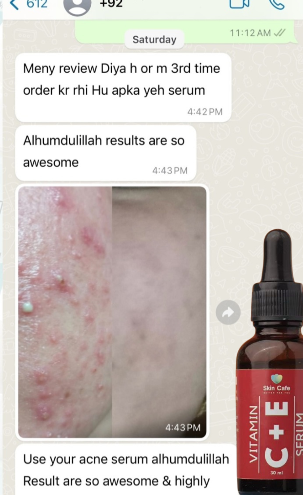 ANTI ACNE & GLOWING SERUM VITAMIN C + E