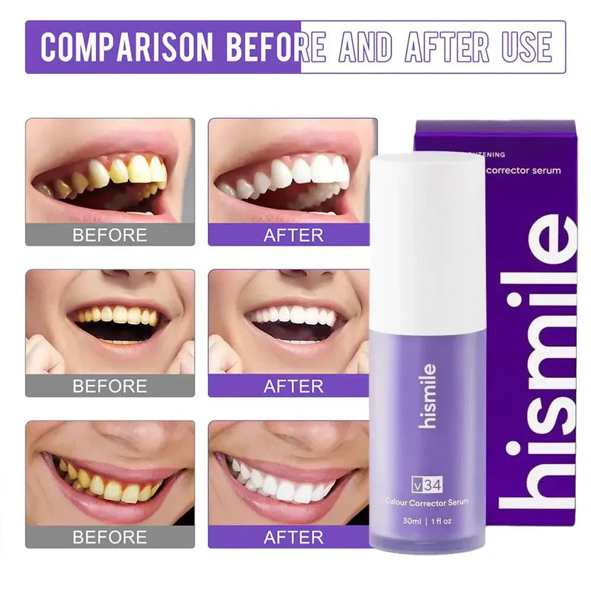 HiSmile V34™ – No More Yellow Stains, Just Bright Smiles