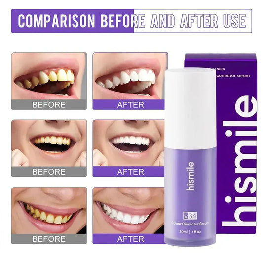 HiSmile V34™ – No More Yellow Stains, Just Bright Smiles